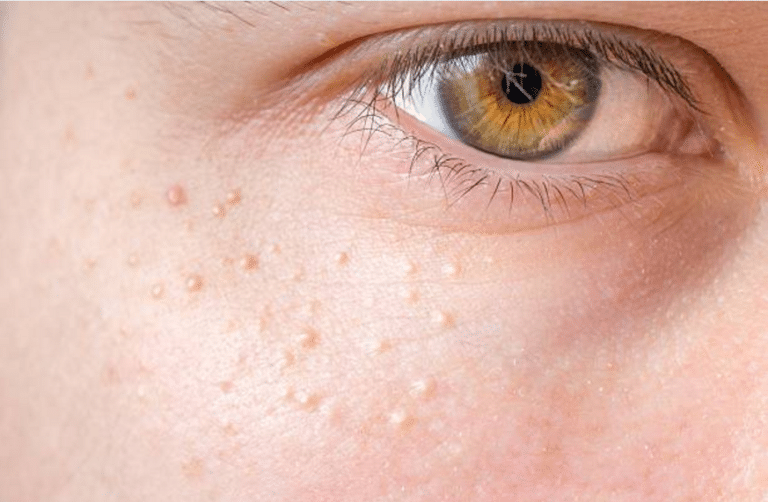 milium grains yeux