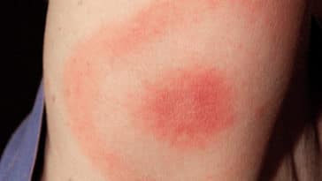 maladie de Lyme tiques