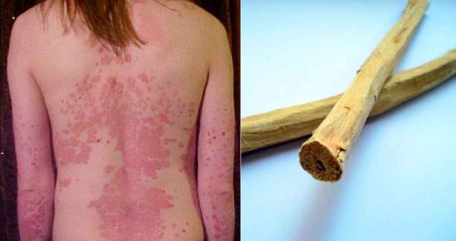 psoriasis