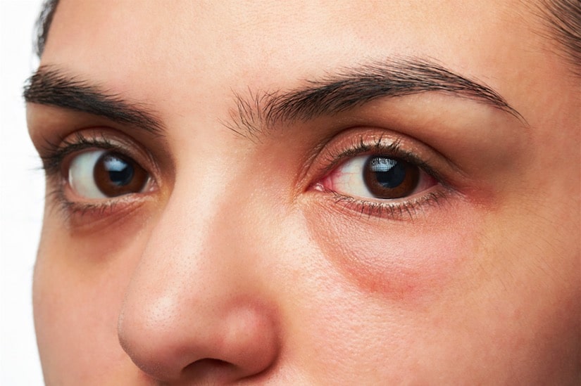 poches sous les yeux