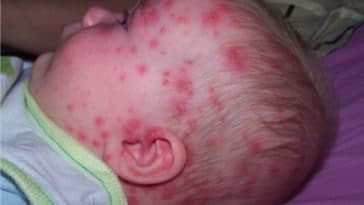 bébé plaques rouges