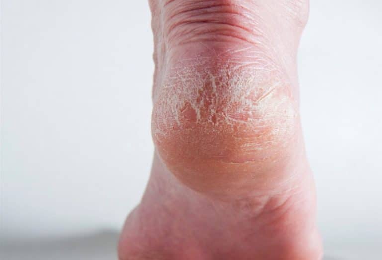 pieds secs cors