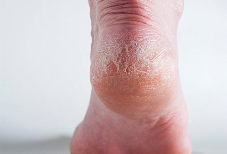 pieds secs cors