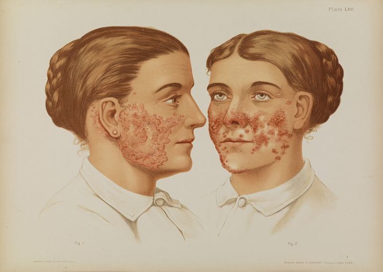 lupus