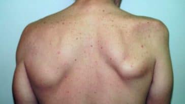 syndrome de parsonage-turner