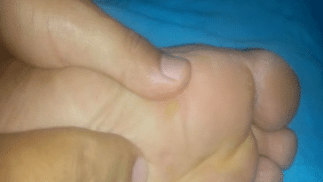 cors durillons aux pieds