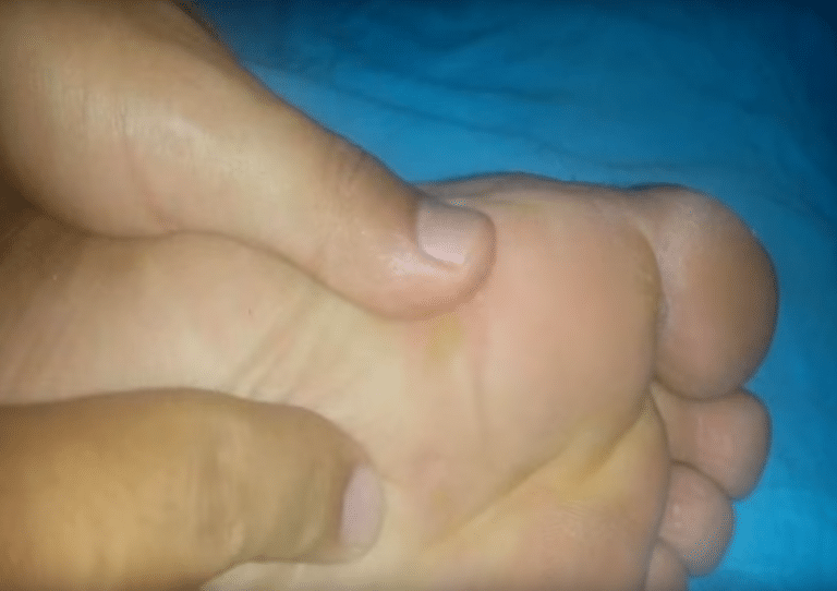cors durillons aux pieds