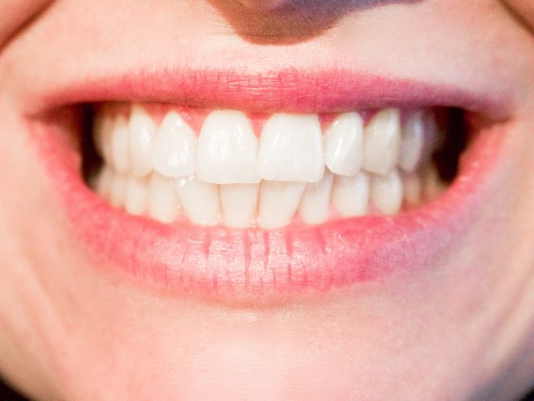 bouche dents blanches caries