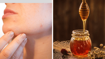 acné remèdes miel