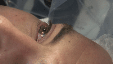 laser opération yeux