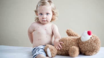 rougeole enfant malade Docteur Tamalou