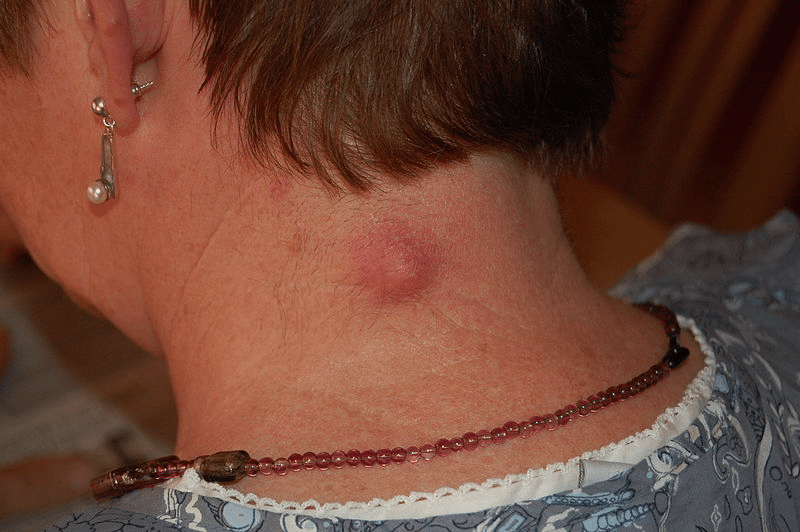 kyste cou bouton rouge