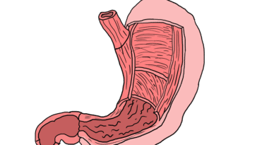 vue en coupe d'un estomac ulcère de l'estomac