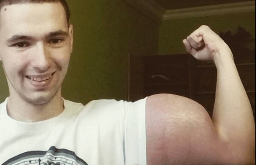 synthol muscles danger