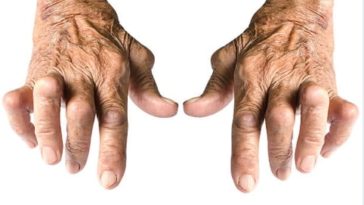 Polyarthrite-iStock