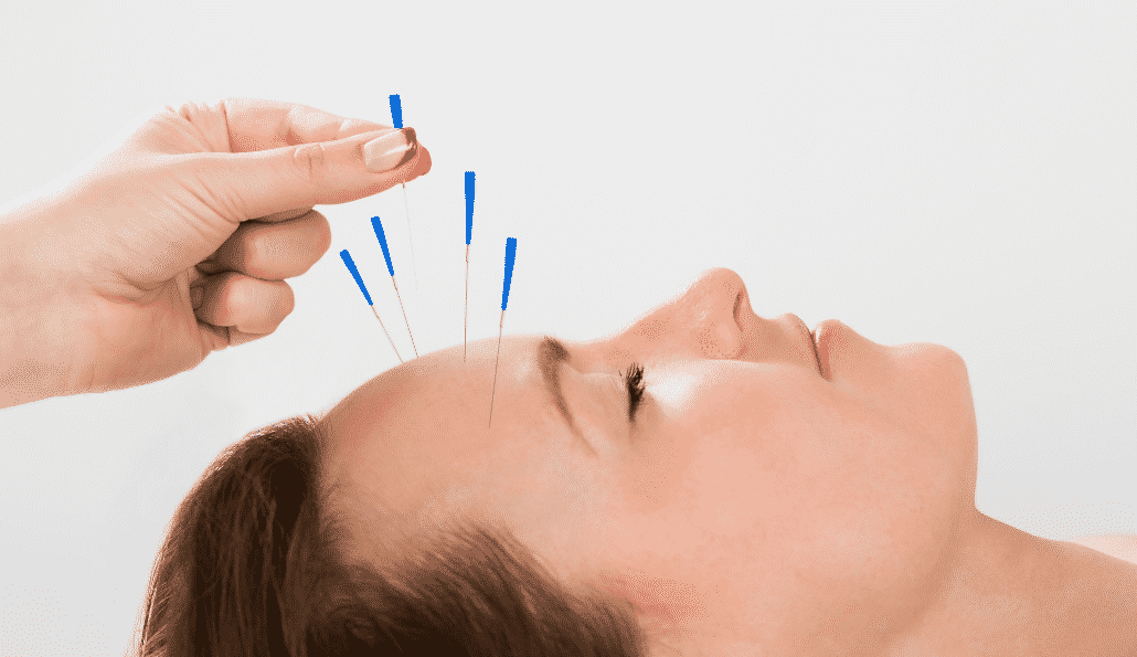acupuncture aiguilles