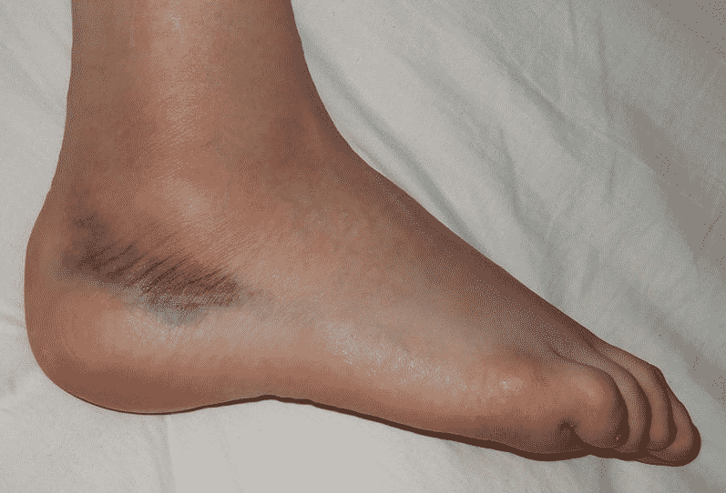 remèdes entorse bleu hématome ecchymose