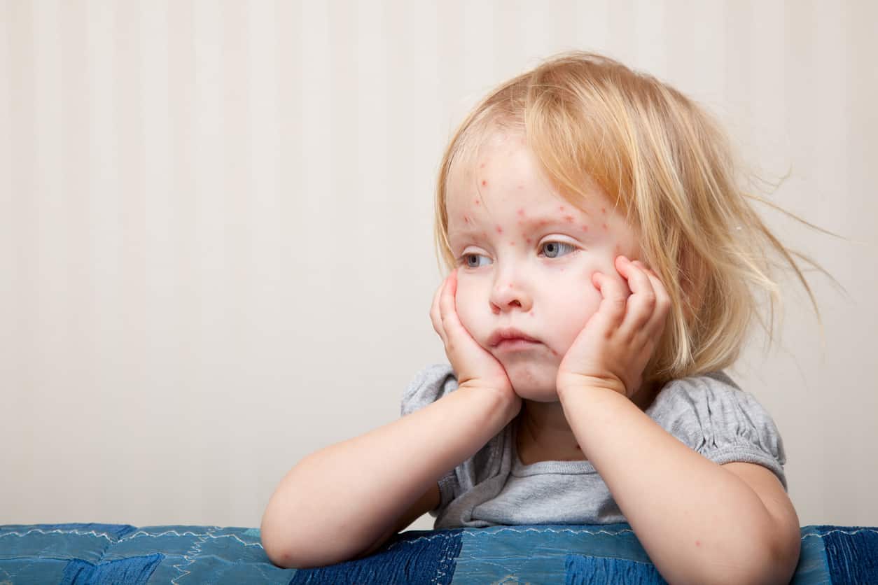 varicelle-enfant-malade-rentrée