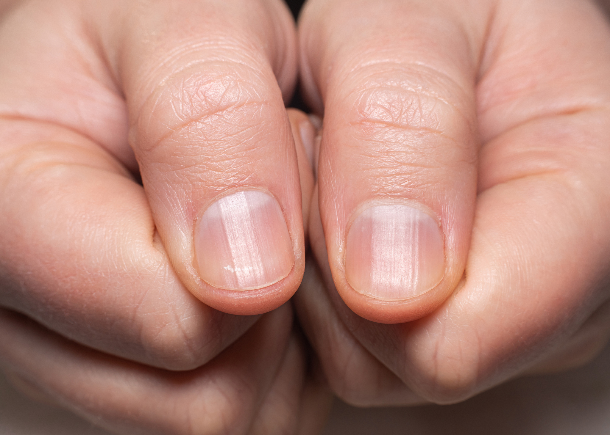 La face cachée des microcarences : quand les ongles tirent la sonnette d'alarme